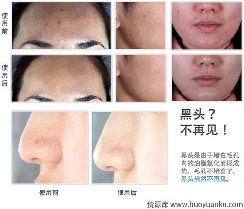 常见面部难题答疑解惑-第19张图片-货源库 常见面部难题答疑解惑-第19张图片-货源库